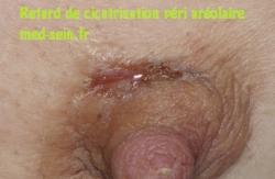 Retard de cicatrisation mammaire med-sein