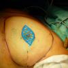 Traces pre operatoire de la mammectomie conservant l etui cutane 3