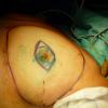 Traces pre operatoire de la mammectomie conservant l etui cutane