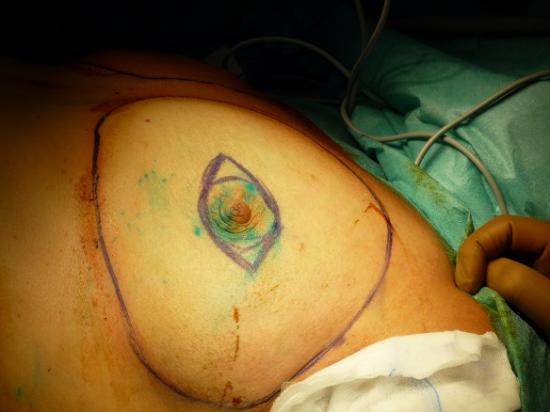 Traces pre operatoire de la mammectomie conservant l etui cutane