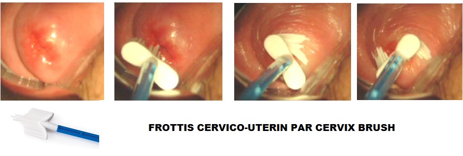 Frottis Cervico-Utérin de Dépistage