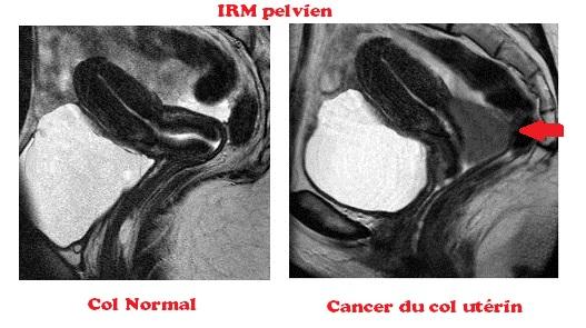 IRM cancer du col et col normal