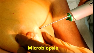 Microbiopsie