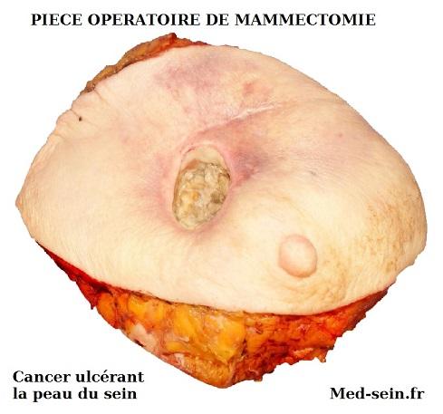 Piece operatoire mammectomie